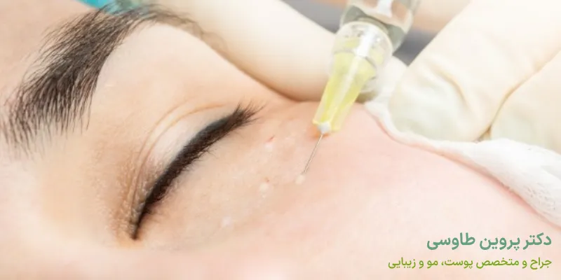 مزوتراپی دور چشم