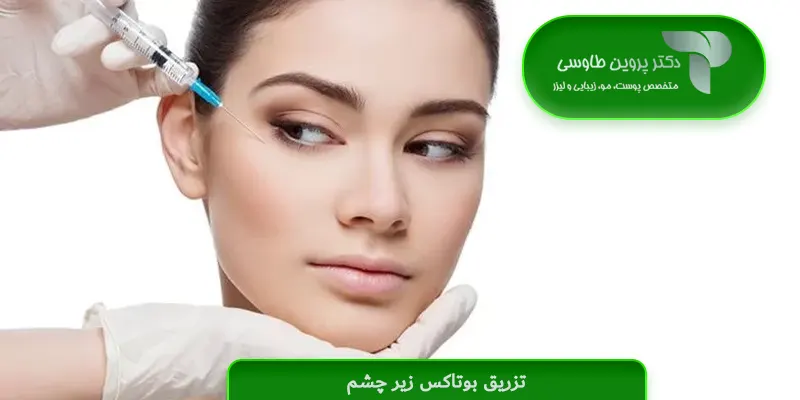 تزریق بوتاکس زیر چشم