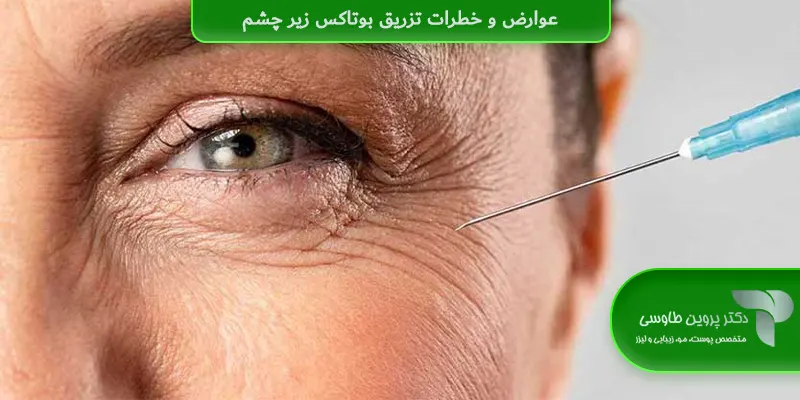 عوارض و خطرات تزریق بوتاکس زیر چشم