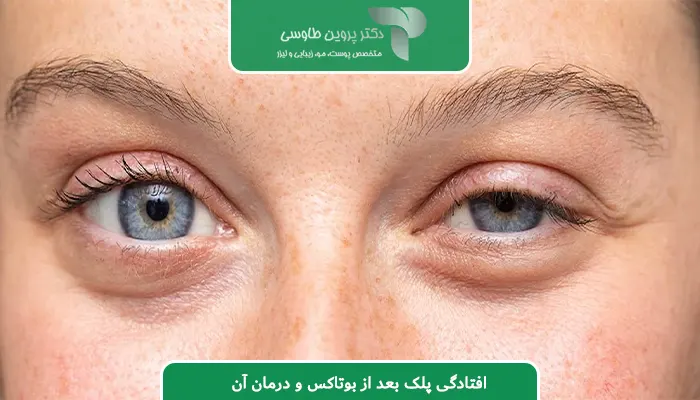 افتادگی پلک بعد از بوتاکس و درمان آن