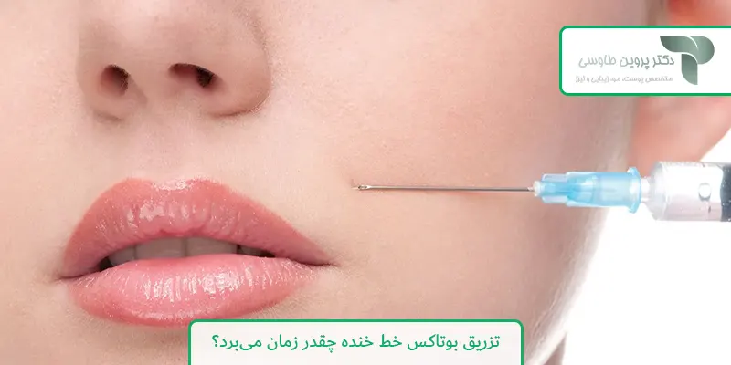 تزریق بوتاکس خط خنده چقدر زمان می‌برد؟
