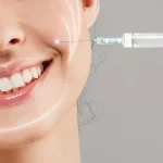 تزریق ژل خط خنده