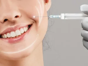 تزریق ژل خط خنده