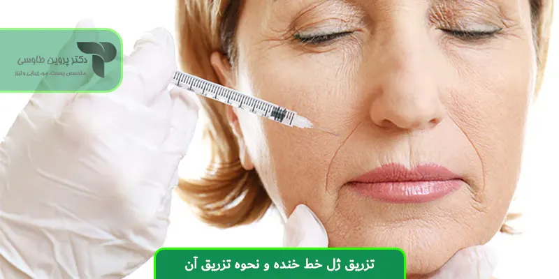 تزریق ژل خط خنده و نحوه تزریق آن