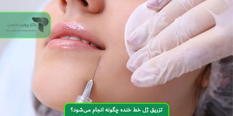 تزریق ژل خط خنده چگونه انجام می‌شود؟