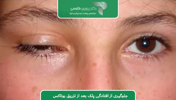 جلوگیری از افتادگی پلک بعد از تزریق بوتاکس
