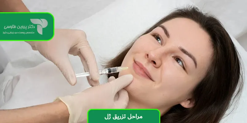 مراحل تزریق ژل
