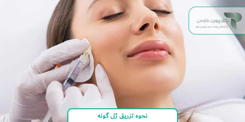نحوه تزریق ژل گونه