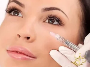 تزریق ژل زیر چشم