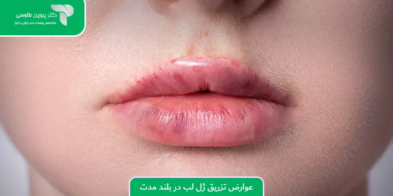عوارض تزریق ژل لب در بلند مدت