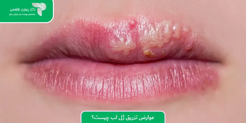 عوارض تزریق ژل لب چیست؟