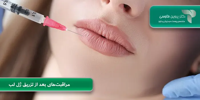 مراقبت‌های بعد از تزریق ژل لب