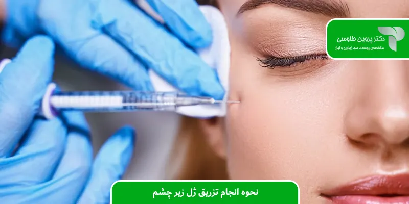 نحوه انجام تزریق ژل زیر چشم