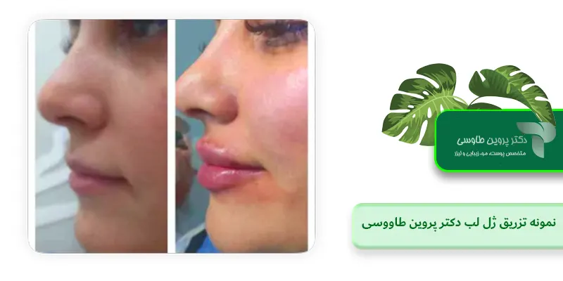 نمونه تزریق ژل لب دکتر پروین طاووسی