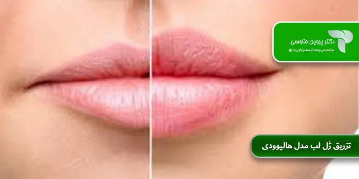 تزریق ژل لب مدل هالیوودی