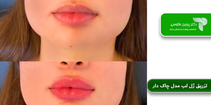 تزریق ژل لب مدل چاک دار