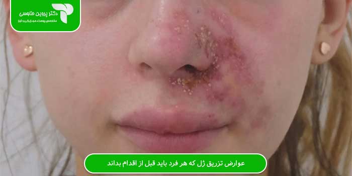عوارض تزریق ژل که هر فرد باید قبل از اقدام بداند: راهنمای کامل