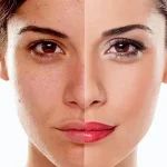 تفاوت کربوکسی تراپی و بوتاکس