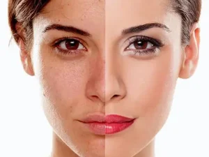 تفاوت کربوکسی تراپی و بوتاکس