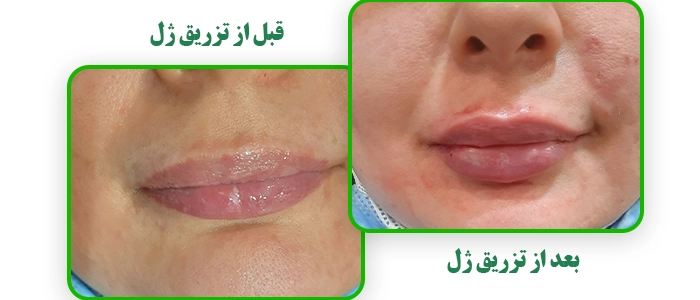 قبل و بعد از تزریق ژل