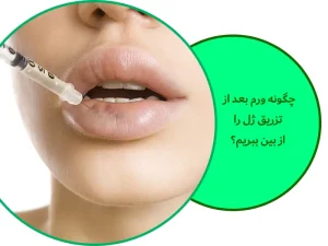 ورم بعد از تزریق ژل