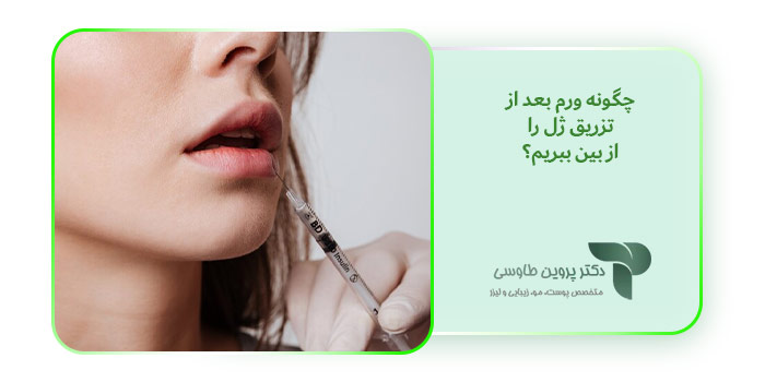 چگونه ورم بعد از تزریق ژل را از بین ببریم؟