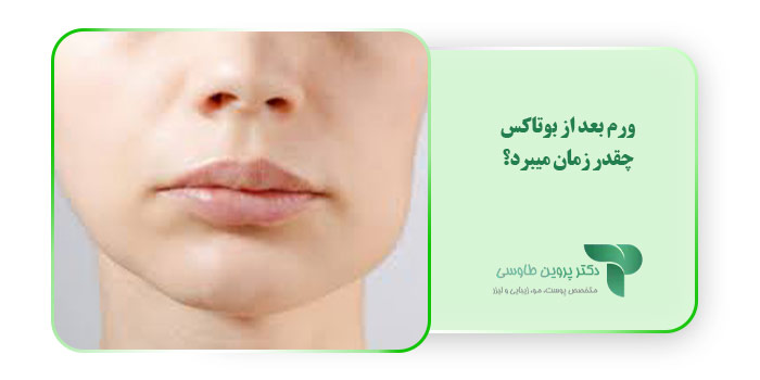 ورم بعد از بوتاکس چقدر زمان میبرد؟