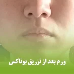 ورم بعد از تزریق بوتاکس