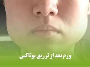 ورم بعد از تزریق بوتاکس