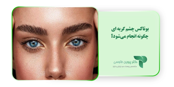 بوتاکس چشم گربه ای چگونه انجام می‌شود؟