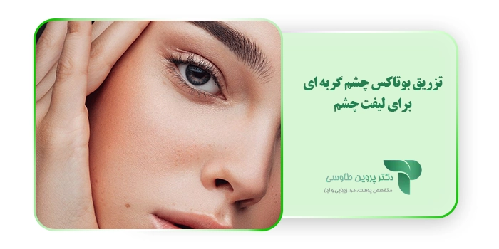 تزریق بوتاکس چشم گربه ای برای لیفت چشم