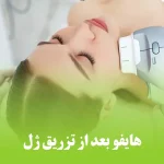هایفو بعد از تزریق ژل