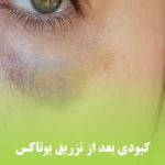 کبودی بعد از تزریق بوتاکس