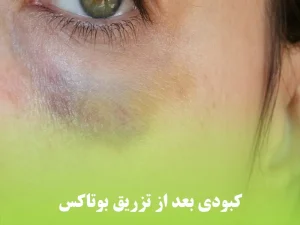 کبودی بعد از تزریق بوتاکس
