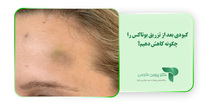 کبودی بعد از تزریق بوتاکس را چگونه کاهش دهیم؟