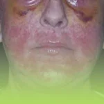 عوارض لیزر co2 فرکشنال