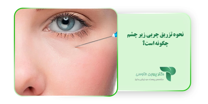 نحوه تزریق چربی زیر چشم چگونه است؟
