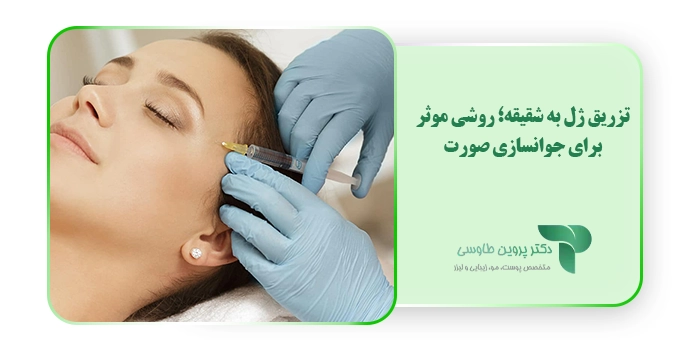 تزریق ژل به شقیقه؛ روشی موثر برای جوانسازی صورت