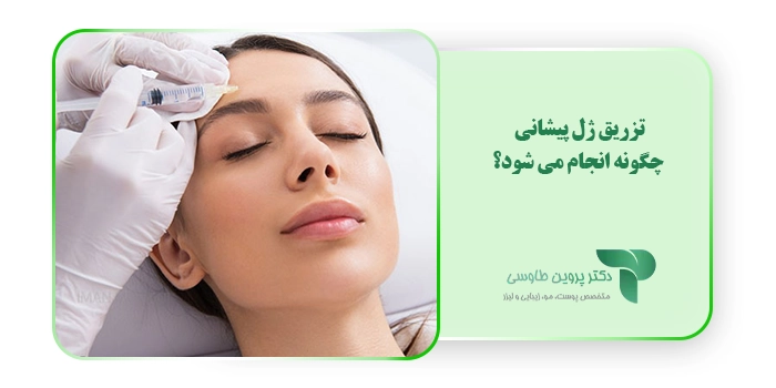 تزریق ژل پیشانی چگونه انجام می شود؟