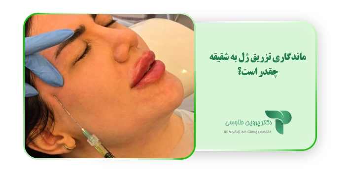 ماندگاری تزریق ژل به شقیقه چقدر است؟