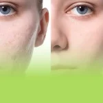 لیزر co2 برای جای جوش