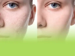لیزر co2 برای جای جوش
