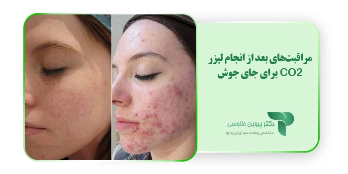 مراقبت‌های بعد از انجام لیزر CO2 برای جای جوش