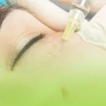 اگزوزوم تراپی زیر چشم