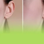 اگزوزوم برای جای جوش