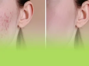 اگزوزوم برای جای جوش
