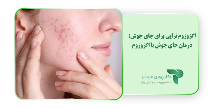 اگزوزوم تراپی برای جای جوش: درمان جای جوش با اگزوزوم