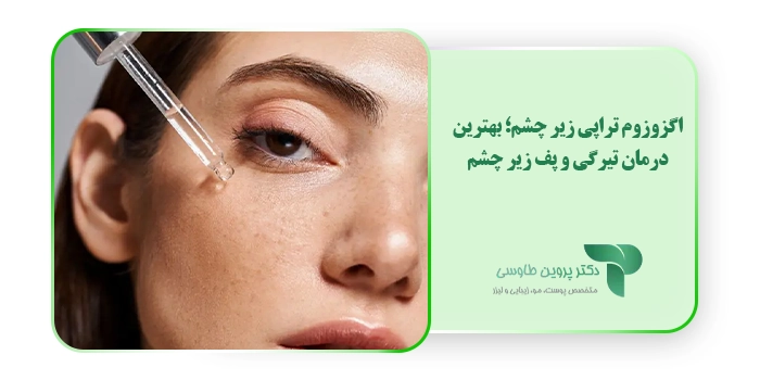 اگزوزوم تراپی زیر چشم؛ بهترین درمان تیرگی و پف زیر چشم