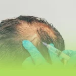 اگزوزوم تراپی مو