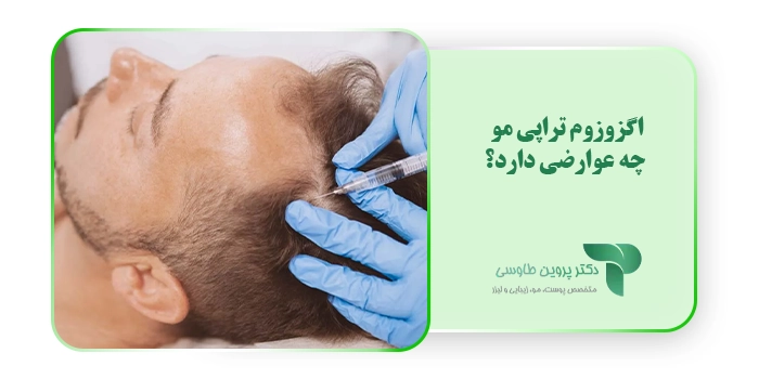 اگزوزوم تراپی مو چه عوارضی دارد؟